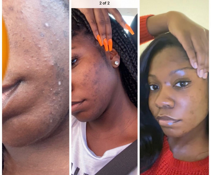 brittnay-skincare-journey-healing