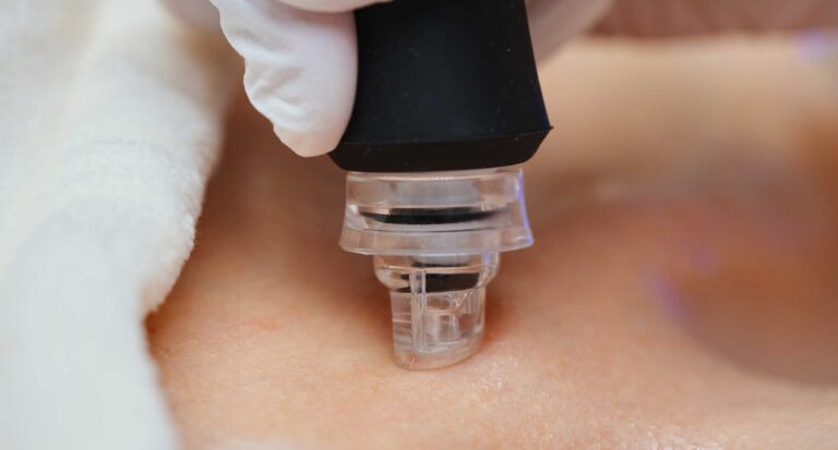 microneedling